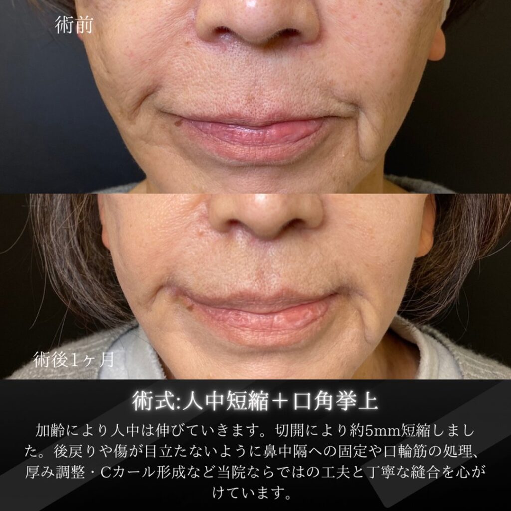 岡山院の人中短縮と口角挙上の１ヶ月後の症例写真