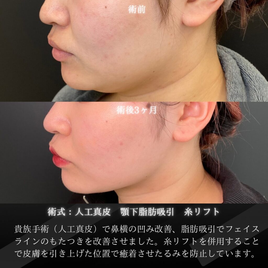 岡山院の貴族手術と顎下の脂肪吸引と糸リフトの３ヶ月後の症例写真