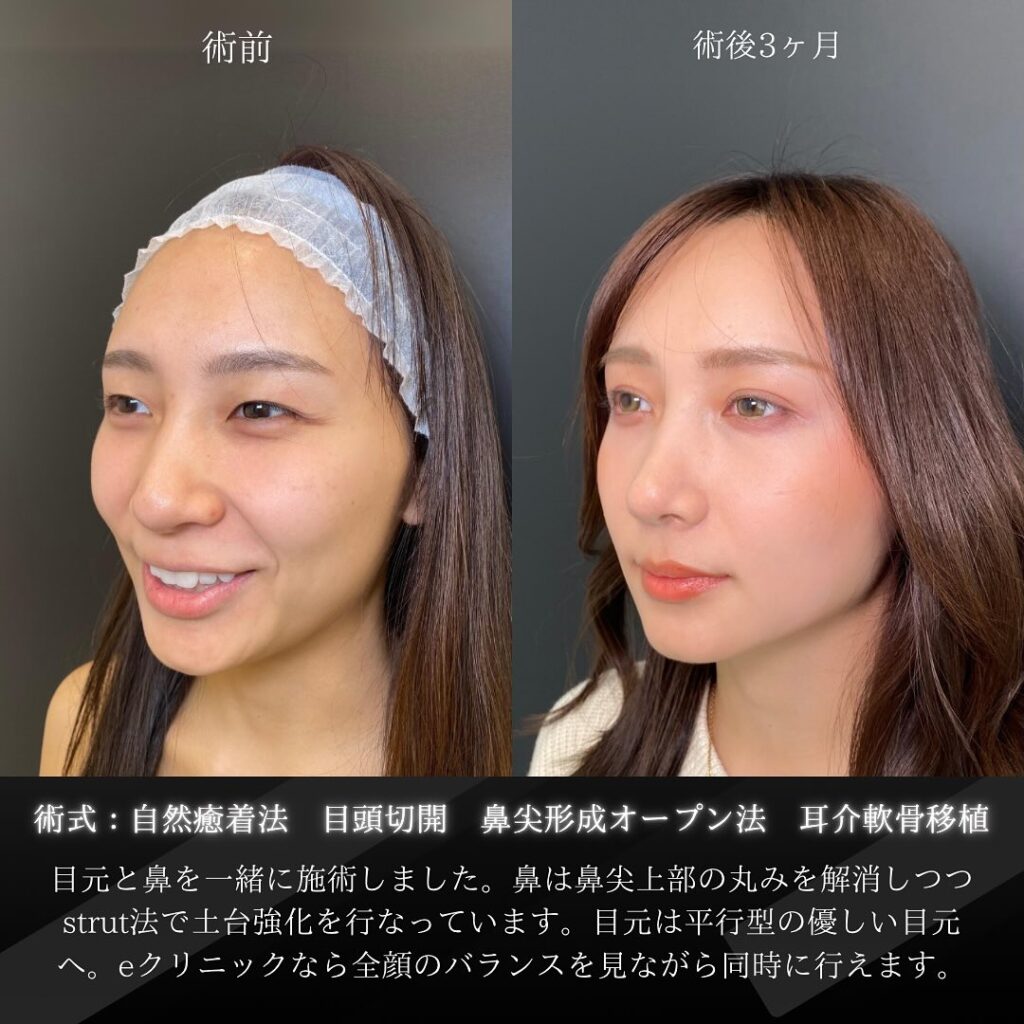 岡山院の自然癒着法と目頭切開と鼻尖形成と耳介軟骨移植の３ヶ月後の症例写真