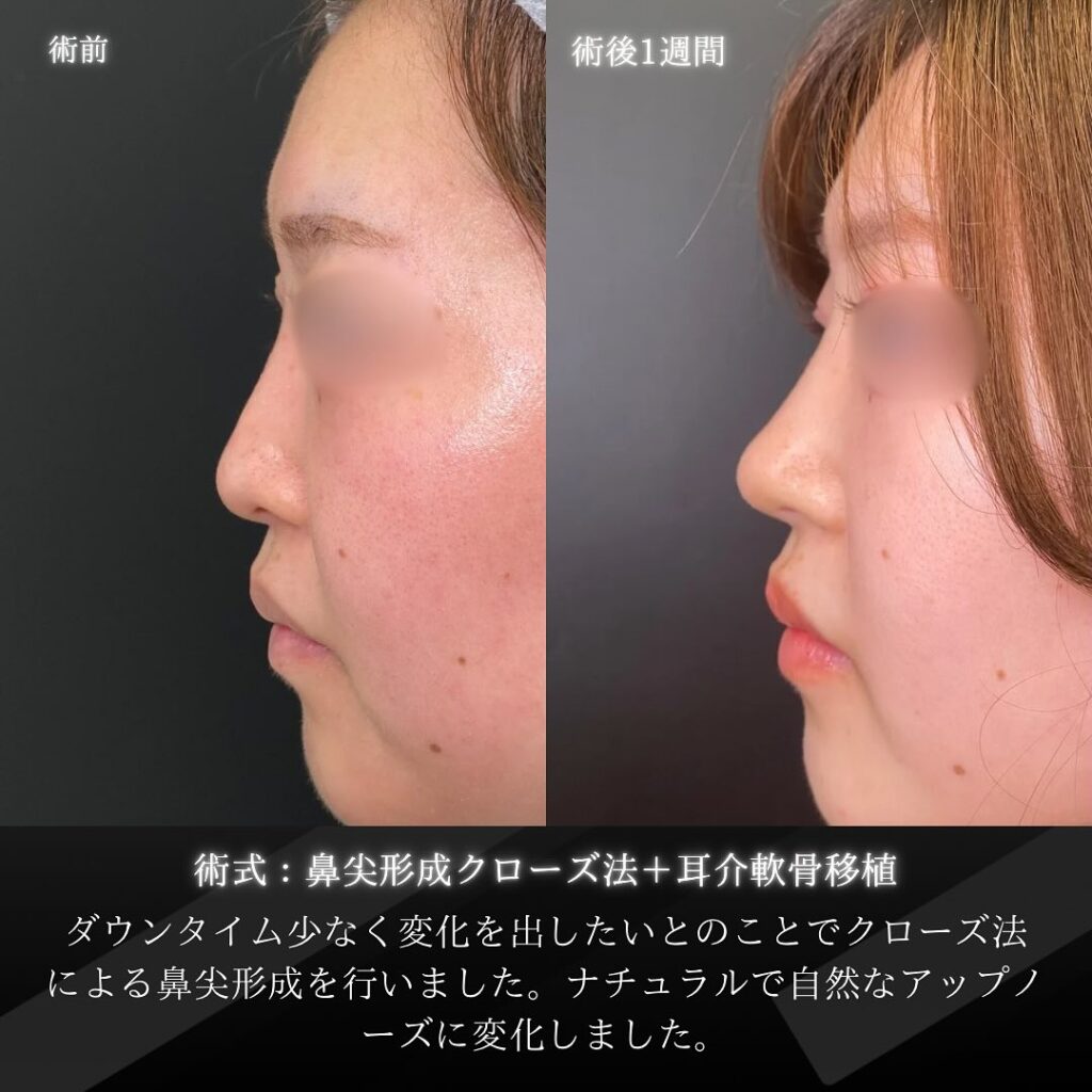 岡山院の鼻尖形成と耳介軟骨移植の症例写真