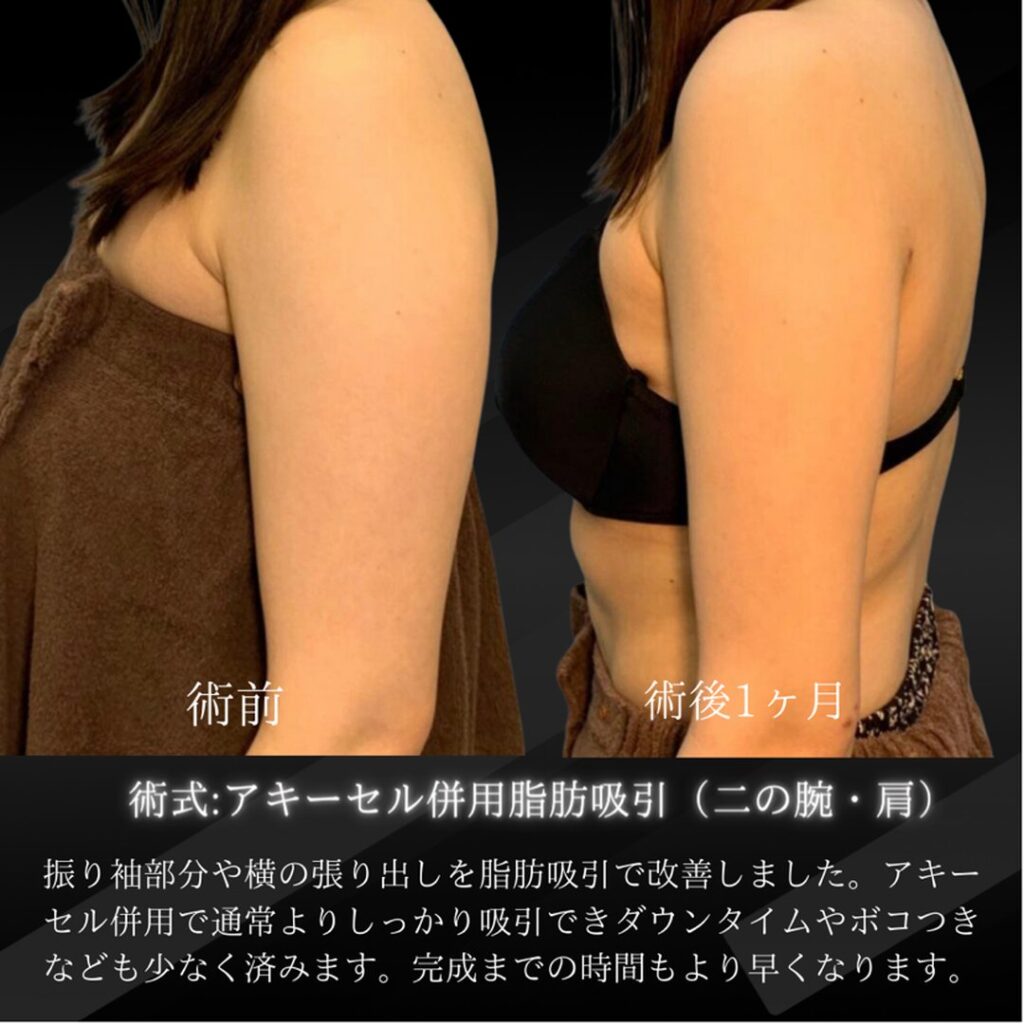岡山院の二の腕と肩のアキーセル脂肪吸引の1か月後の症例