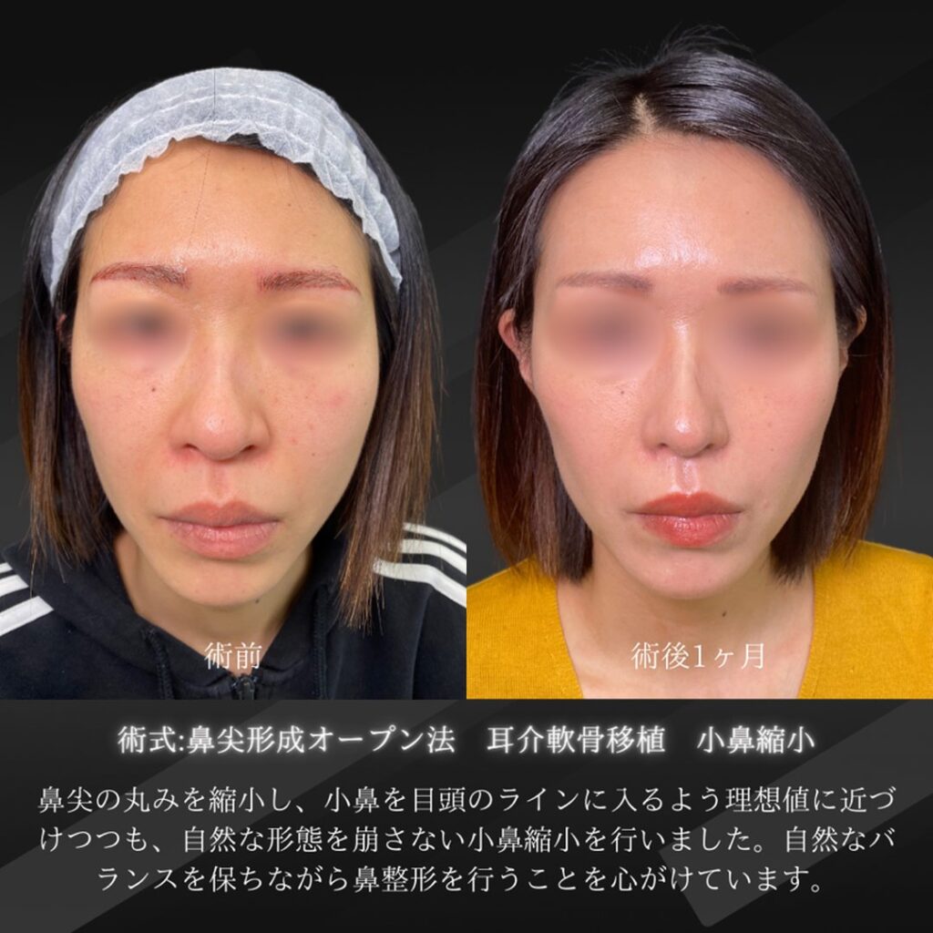 岡山院の鼻尖形成と小鼻縮小と耳介軟骨移植の１ヶ月後の症例写真