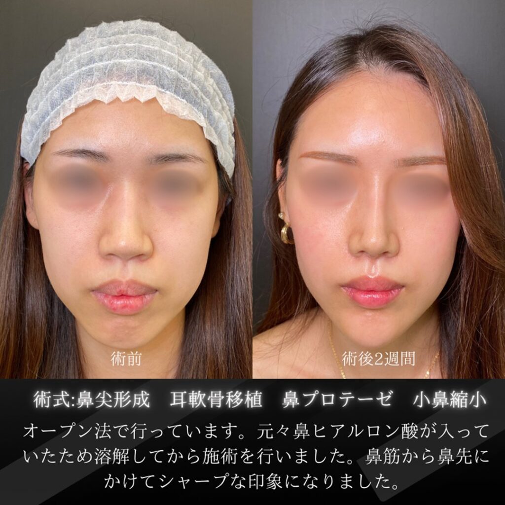 岡山院の鼻尖形成と小鼻縮小とプロテーゼと耳軟骨移植の２週間後の症例写真