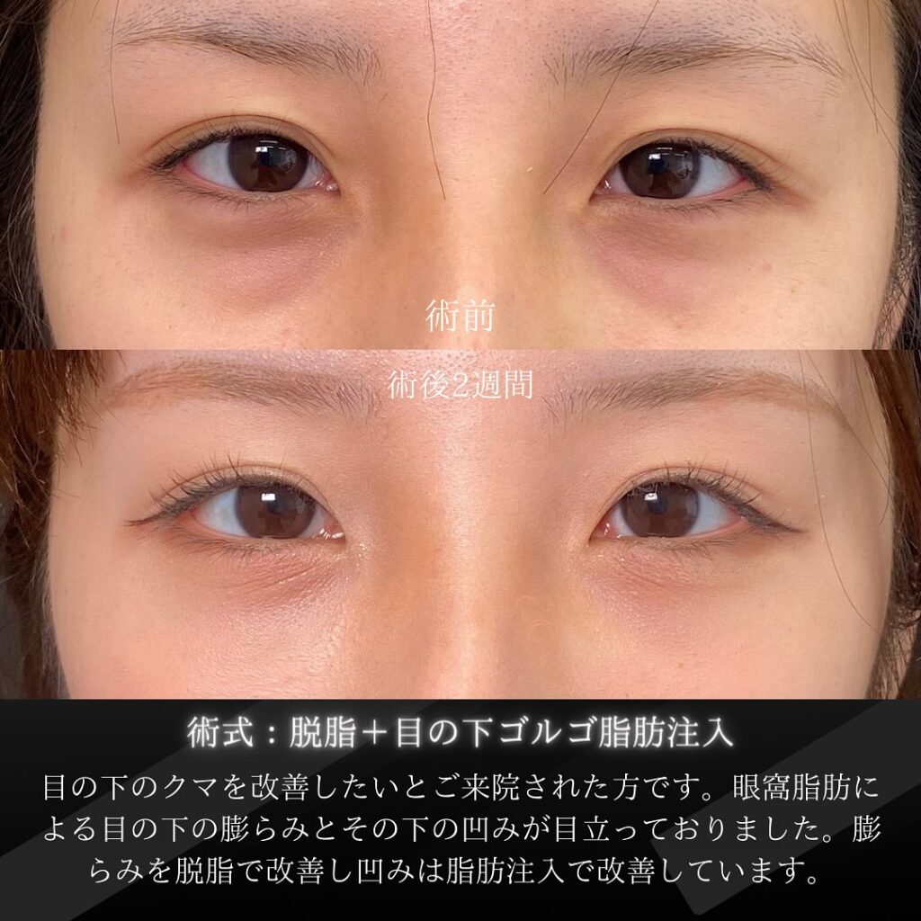 岡山院の経結膜脱脂と目の下のゴルゴ線の脂肪注入の症例写真