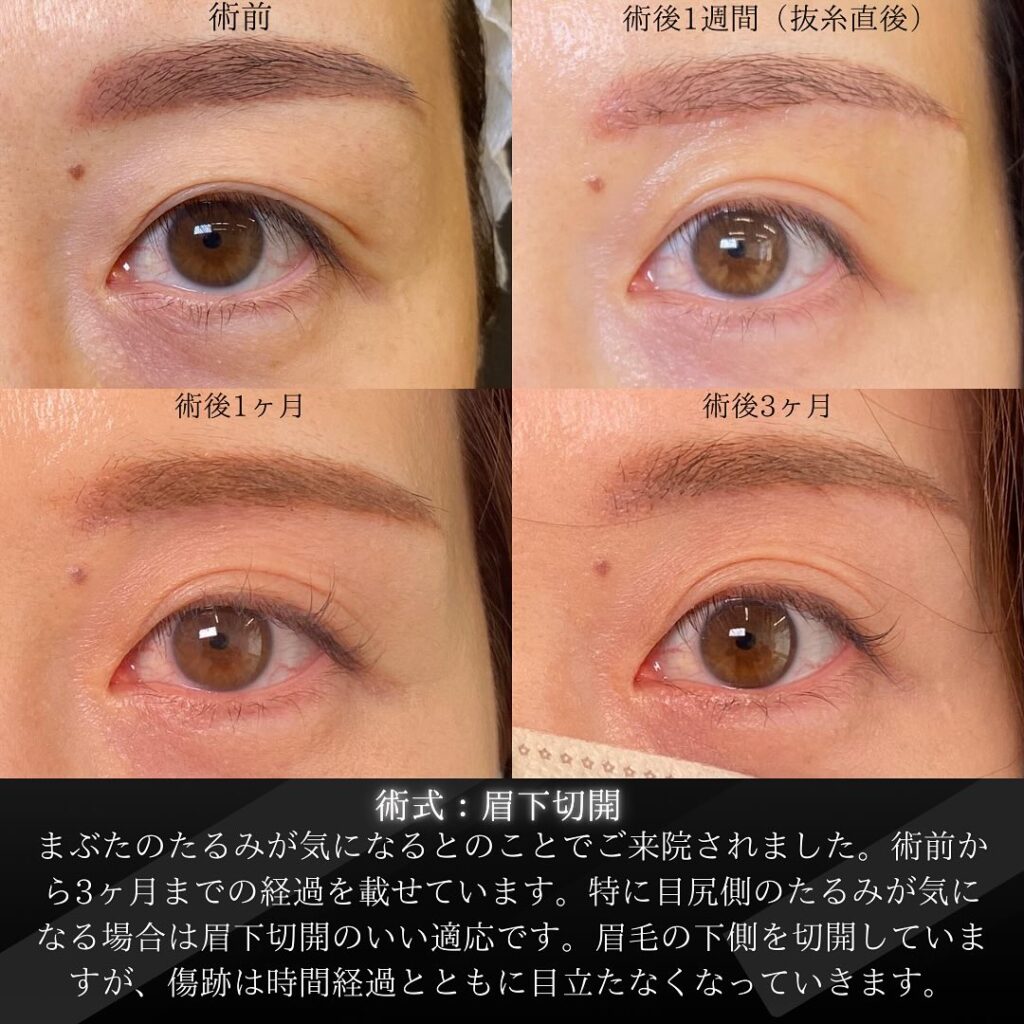 岡山院の眉下切開の１週間後と１ヶ月後と３ヶ月後の症例写真