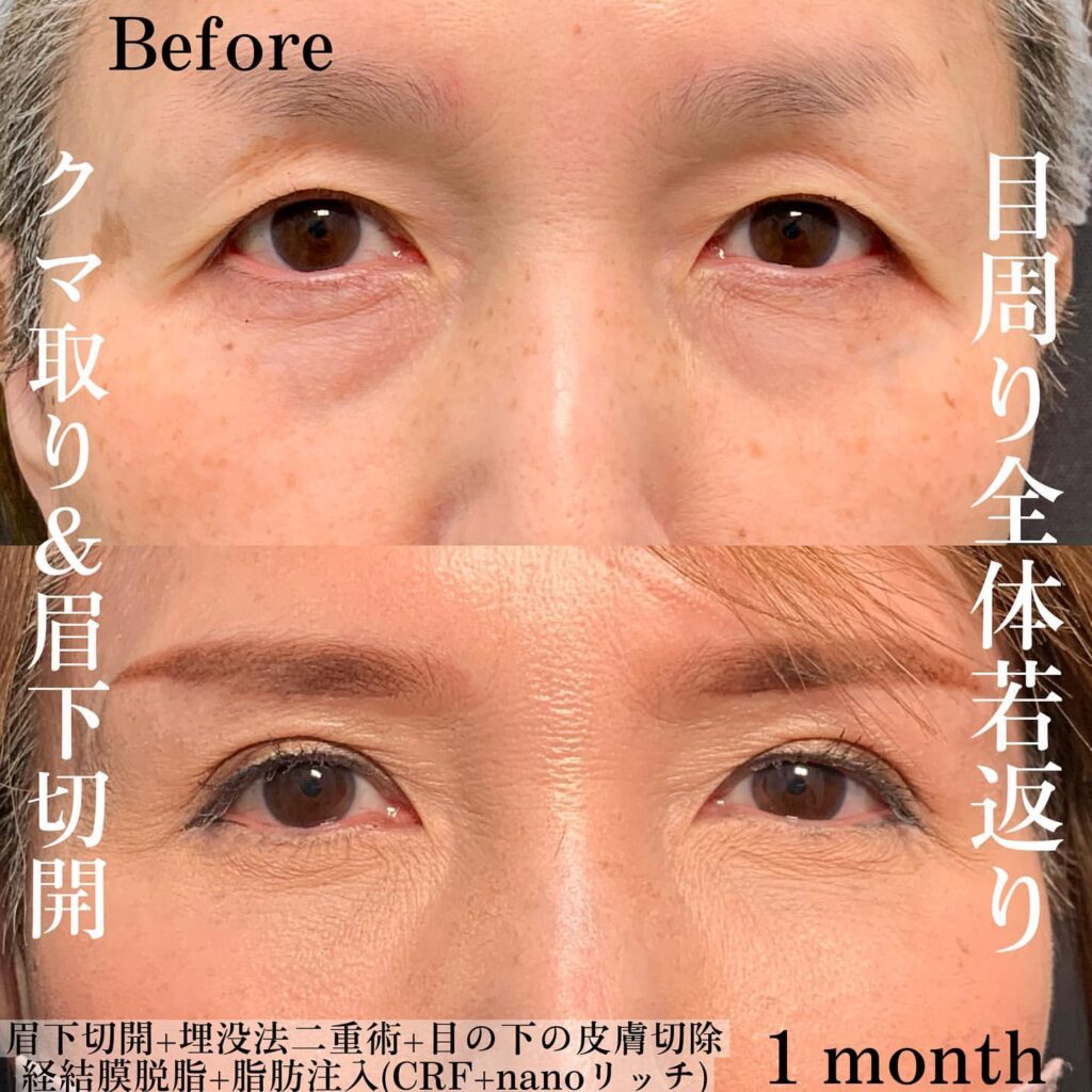 eクリニック岡山院の経結膜脱脂と脂肪注入と埋没法と眉下切開の症例写真(4)