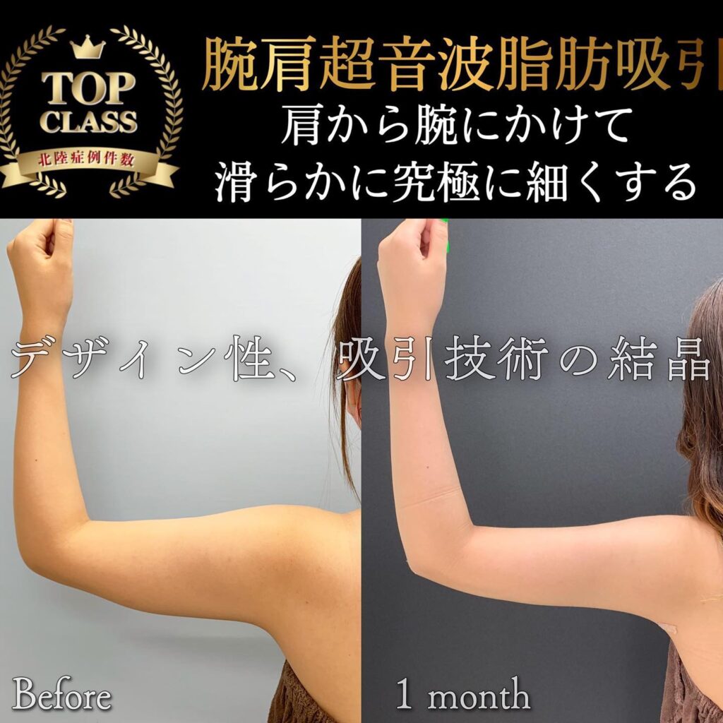 二の腕の脂肪吸引 (2)