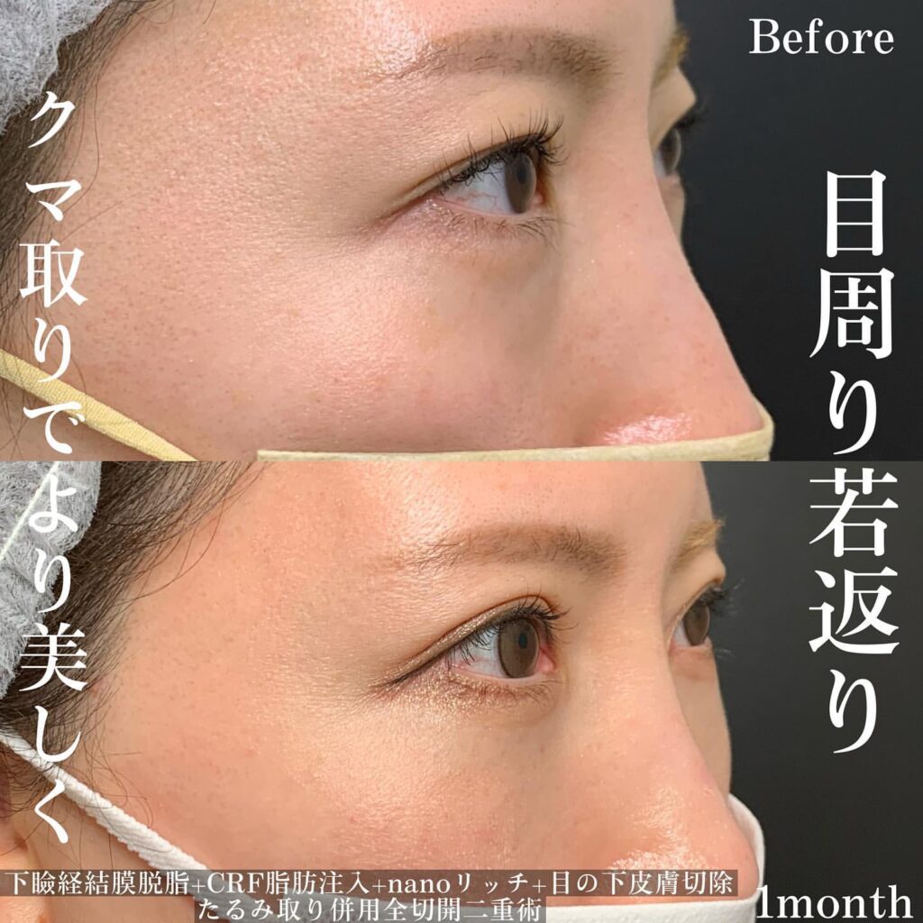 eclinic岡山院の目の上脱脂+脂肪注入ナノリッチ+皮膚切開+たるみ取り併用全切開二重術