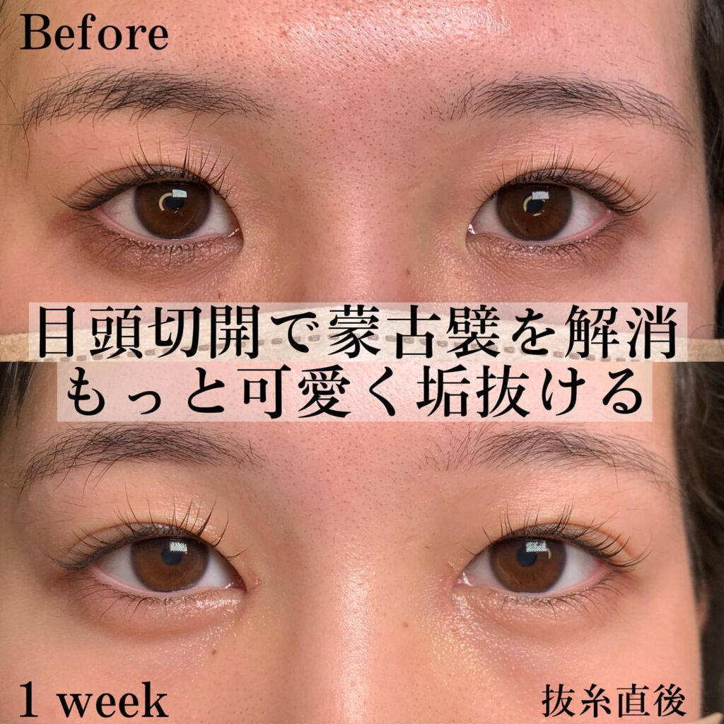目頭切開の症例写真