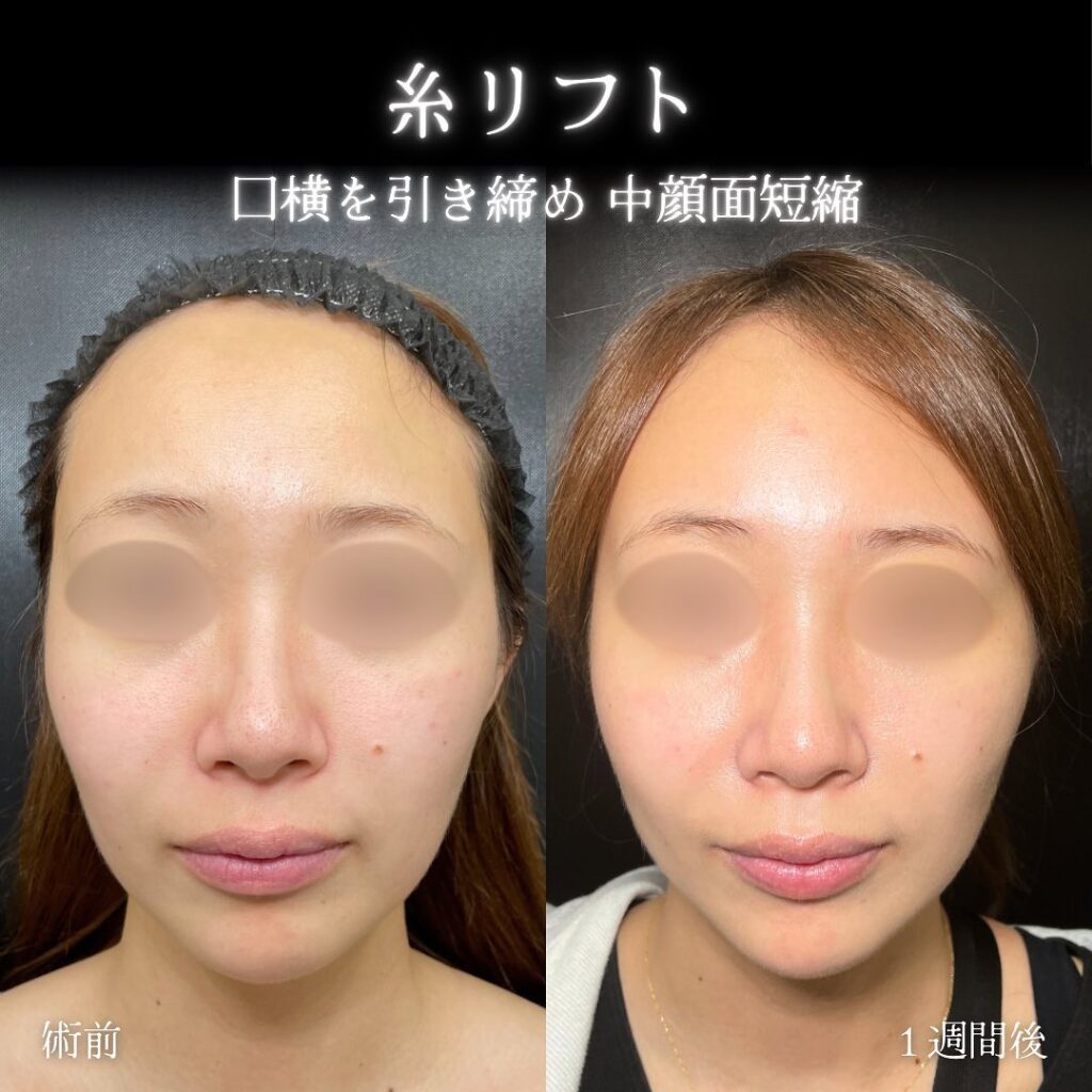 糸リフトの症例写真 (7)