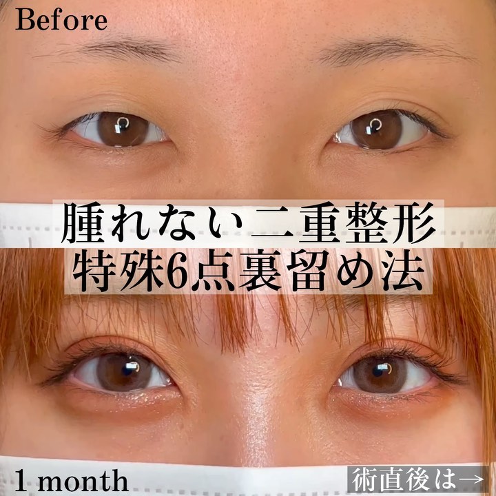 eclinic岡山院の埋没法(特殊6点裏留め法)