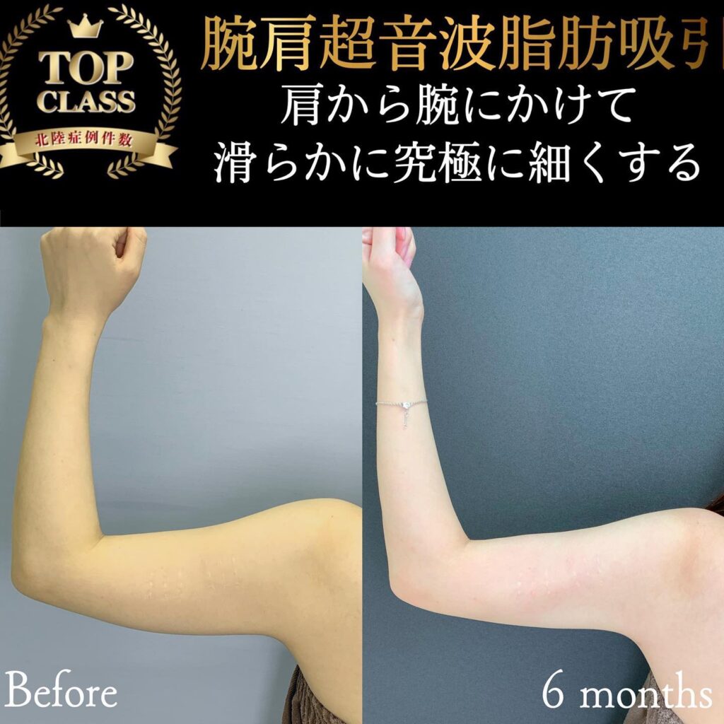 二の腕の脂肪吸引 (7)