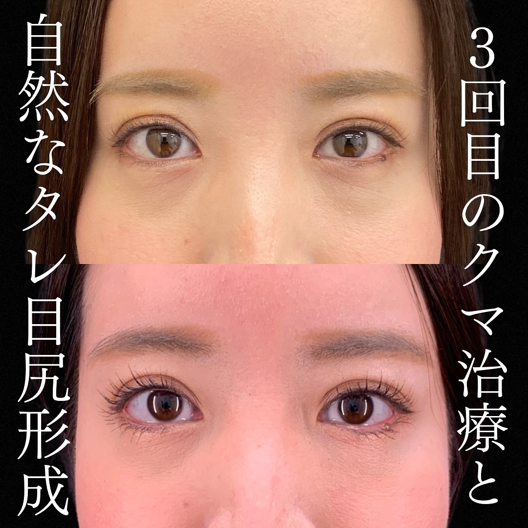 3回目のクマ治療とタレ目尻形成 | eクリニック岡山院【公式】｜美容