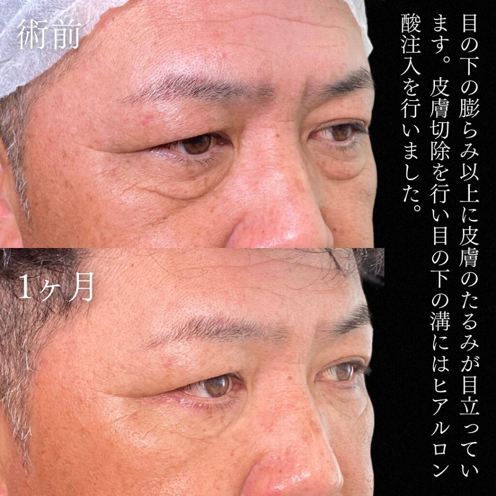 経結膜脱脂と皮膚切除の症例写真