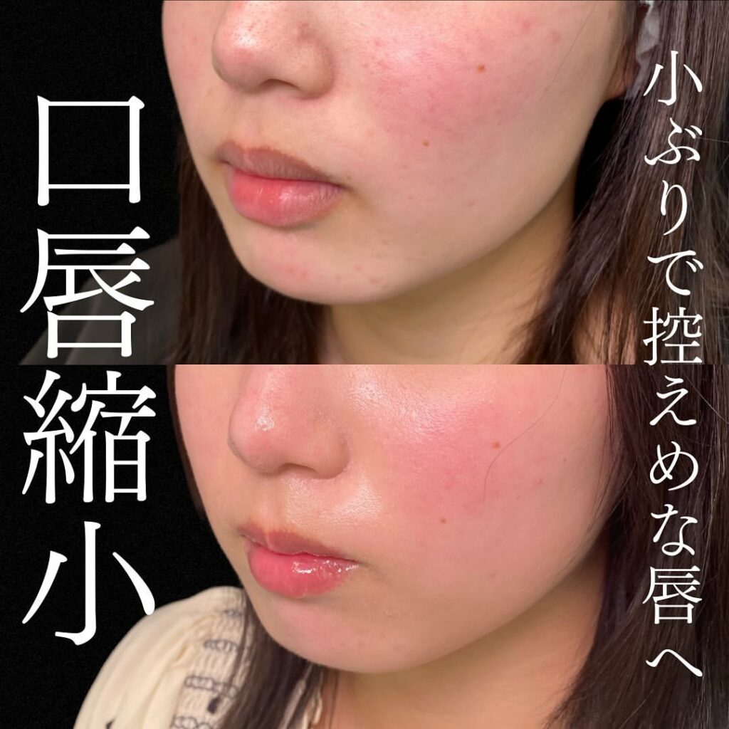 口唇縮小の症例写真 (4)