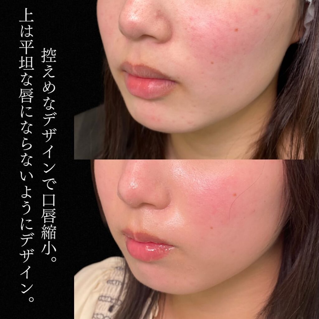 口唇縮小の症例写真 (3)