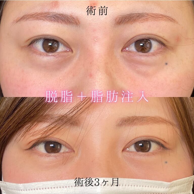eクリニック岡山院の経結膜脱脂の症例写真(5)
