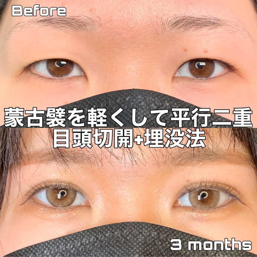 目頭切開と埋没法を併用した症例写真