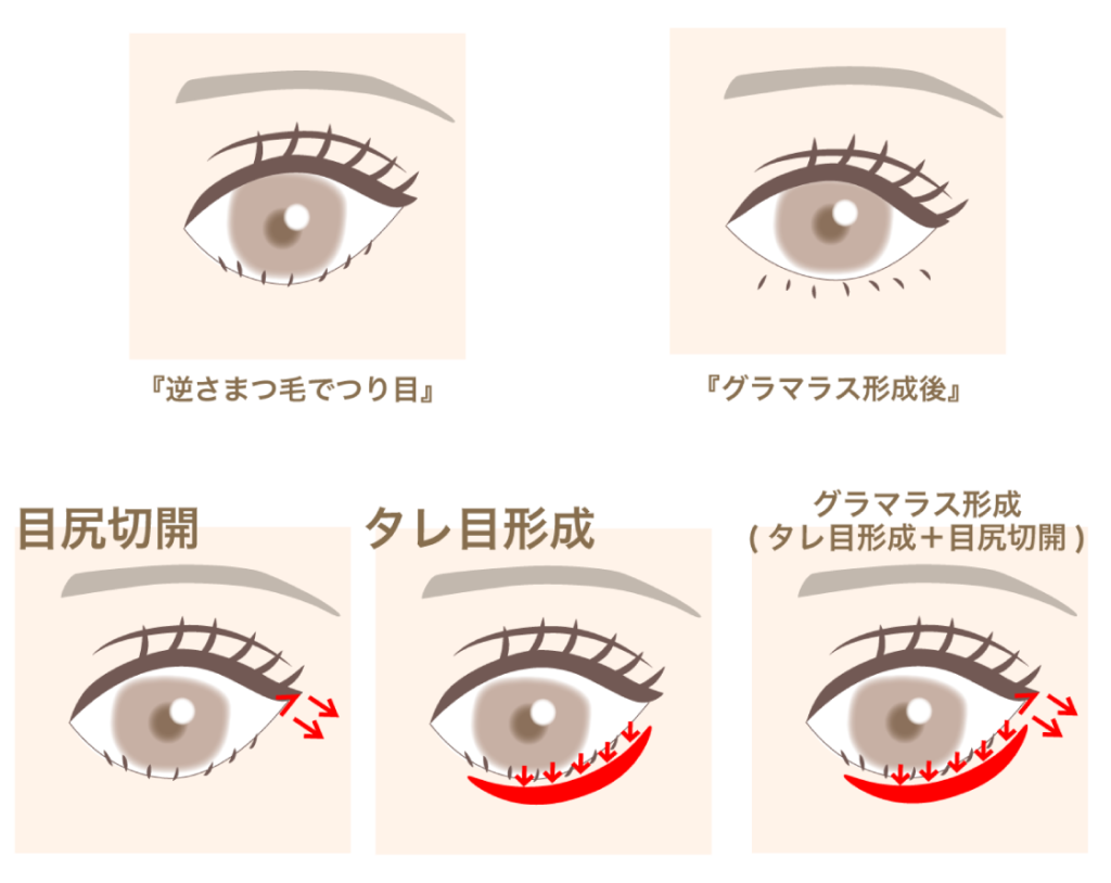 目尻切開とタレ目形成の図解