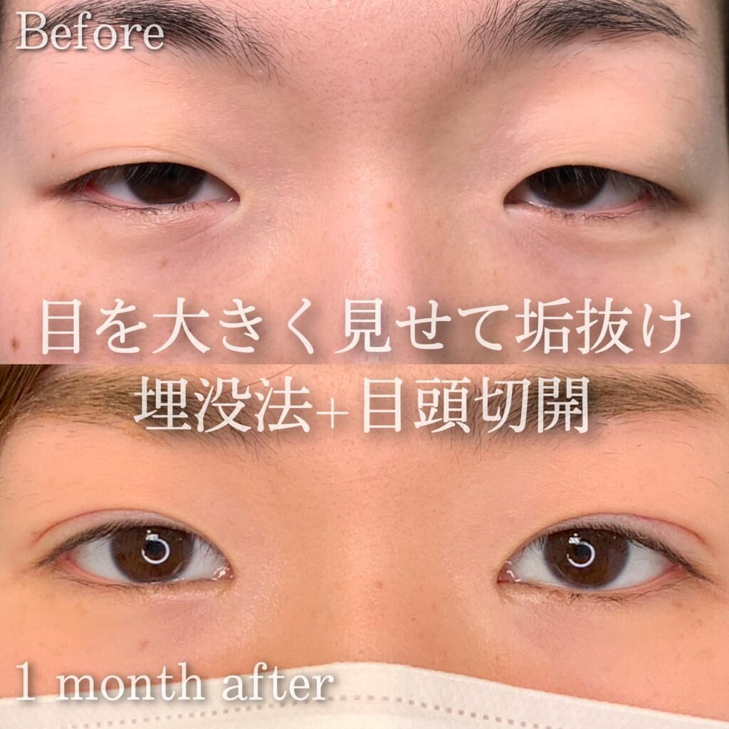 埋没法と目頭切開の症例写真