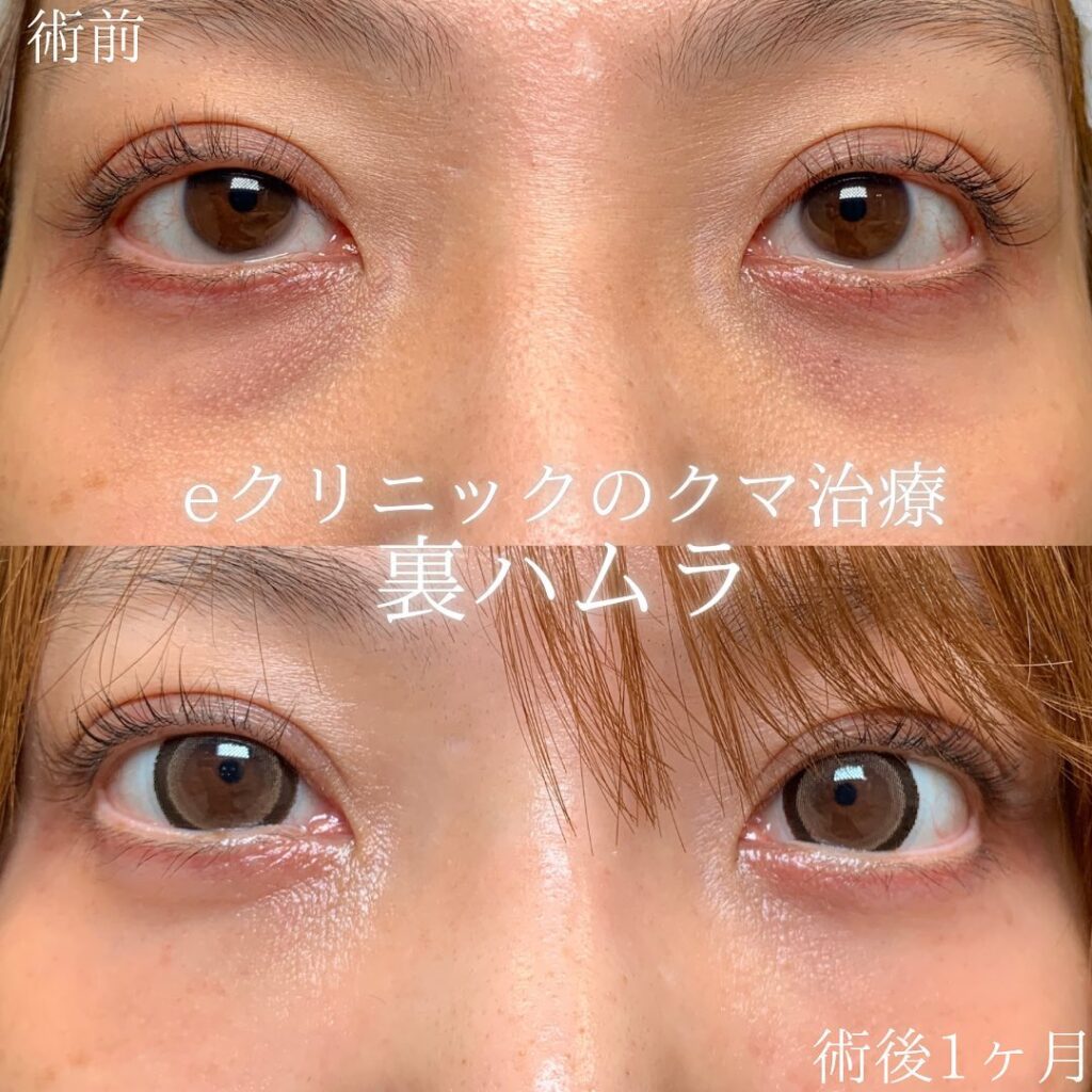 eクリニック岡山院の裏ハムラの症例画像(1)