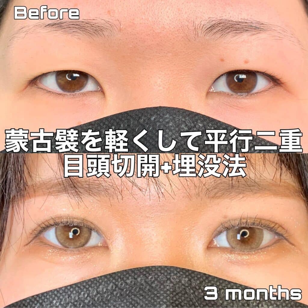 eclinic岡山院の埋没法+目頭切開