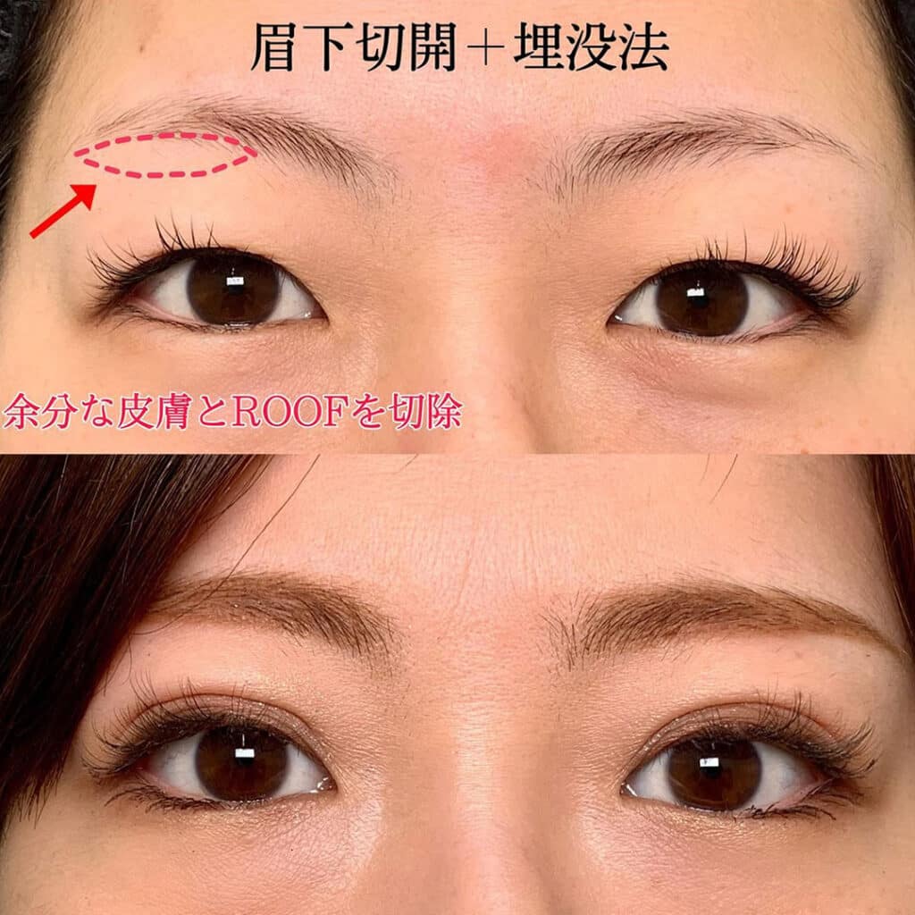 eclinic岡山院の二重埋没法+眉下切開