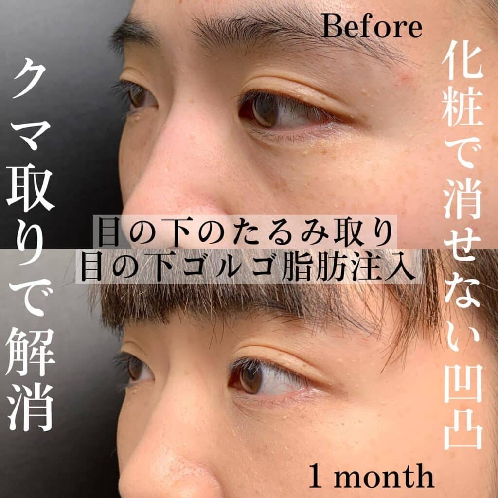 クマ取り_脱脂+脂肪注入の症例写真