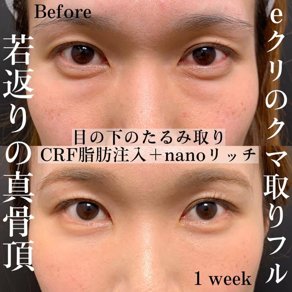 クマ取り_脱脂+脂肪注入の症例写真