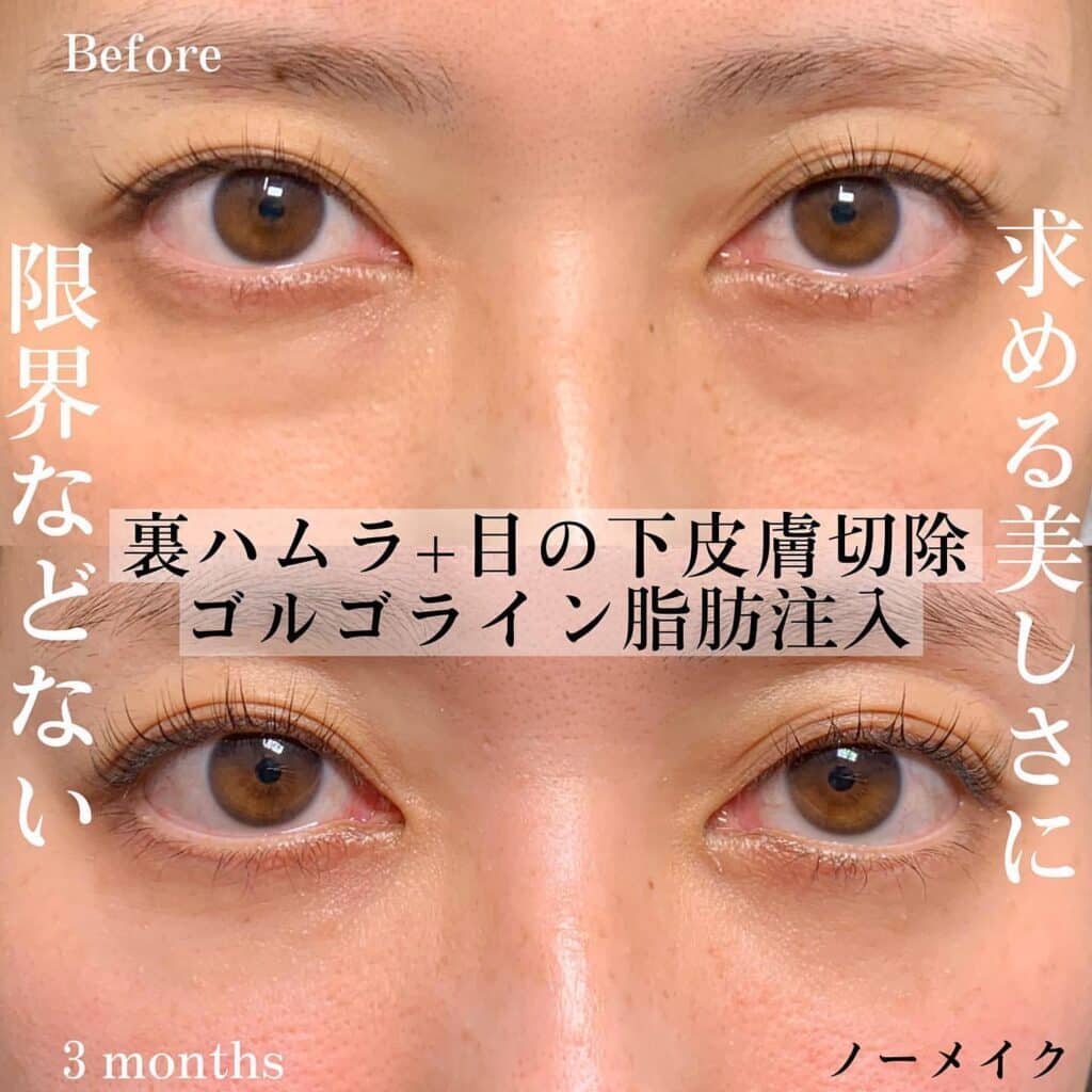 クマ取り_裏ハムラ+目の下皮膚切除+ゴルゴライン脂肪注入の症例写真