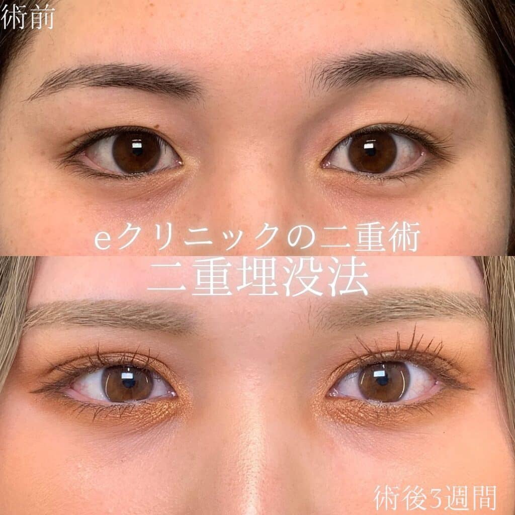 eclinic岡山院の二重埋没法