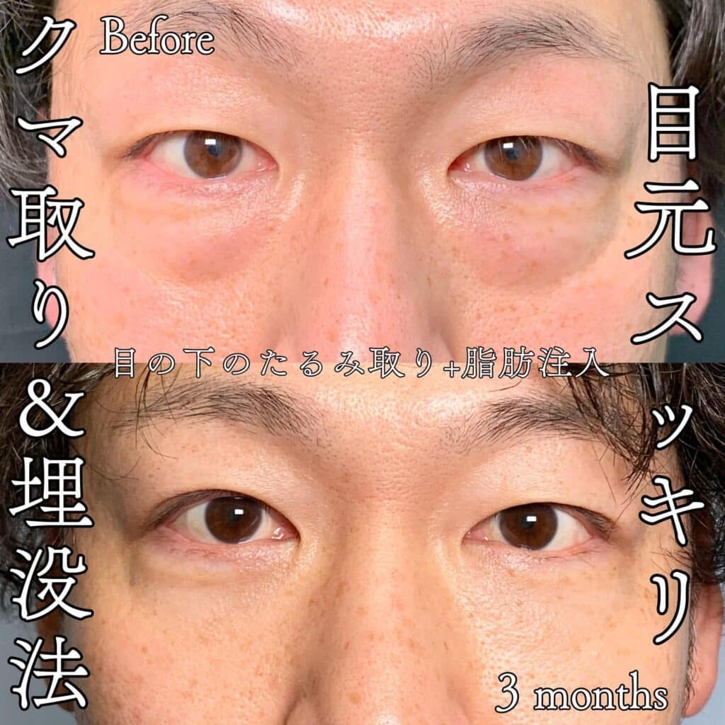 クマ取り_脱脂+脂肪注入の症例写真