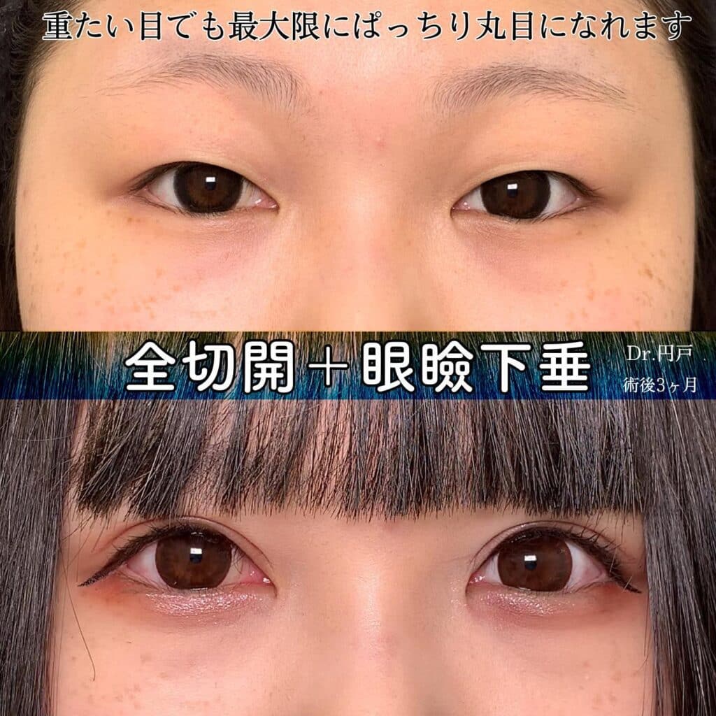 eclinic岡山院の全切開二重術+眼瞼下垂
