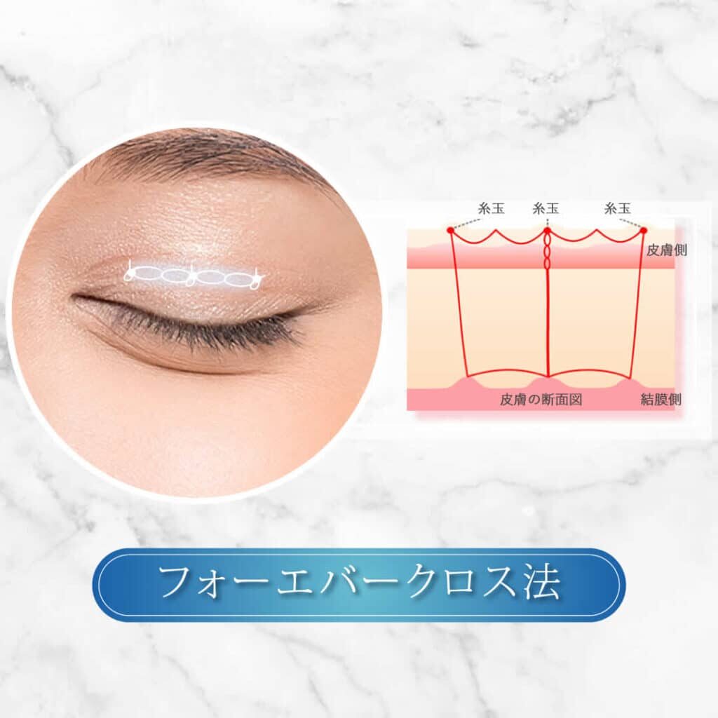 フォーエバークロス法