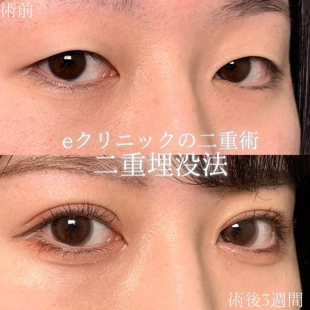 eclinic岡山院の埋没法