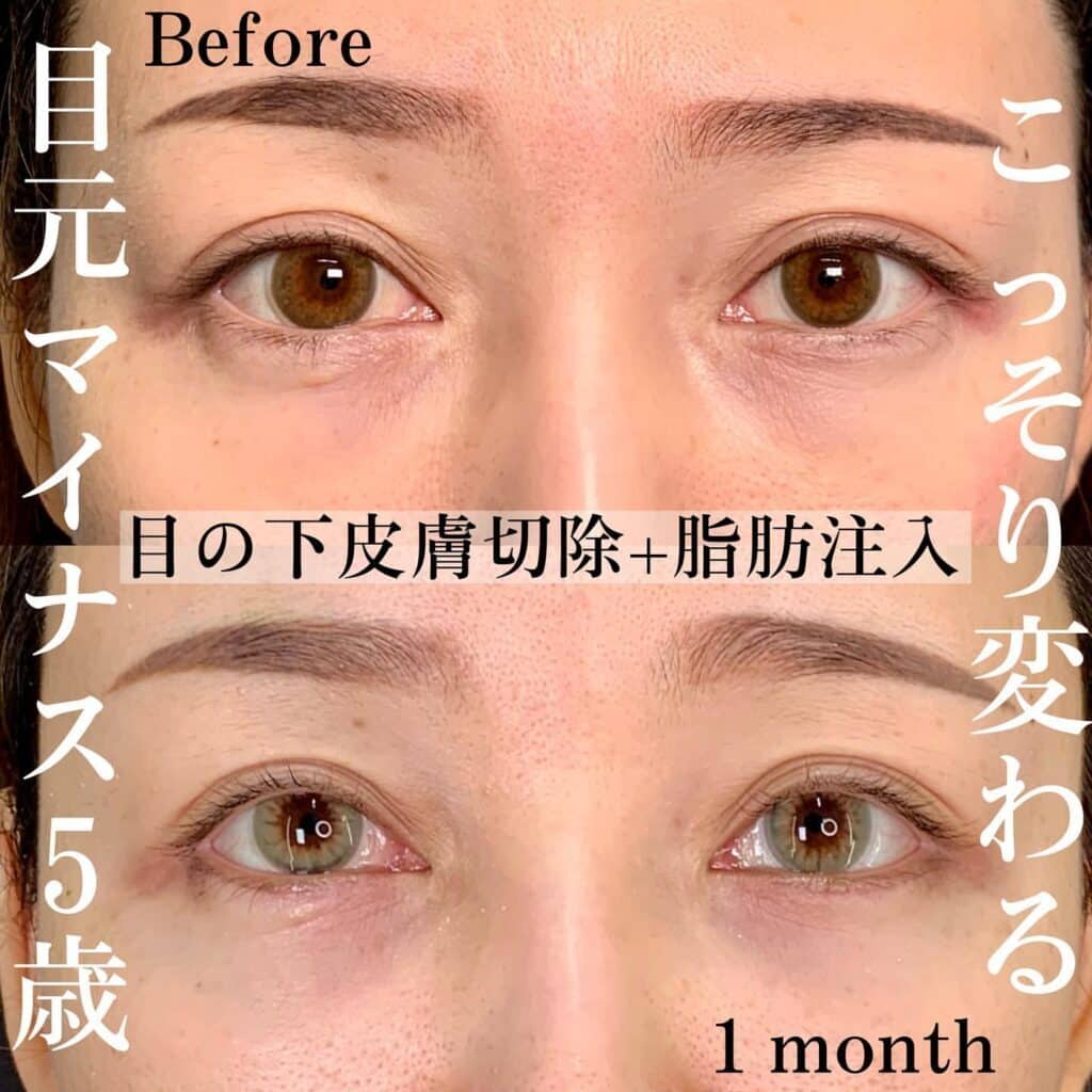 クマ取り_目の下皮膚切除+脂肪注入の症例写真