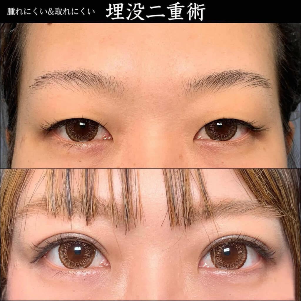 eclinic岡山院の二重埋没法