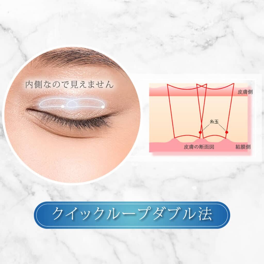 クイックループダブル法