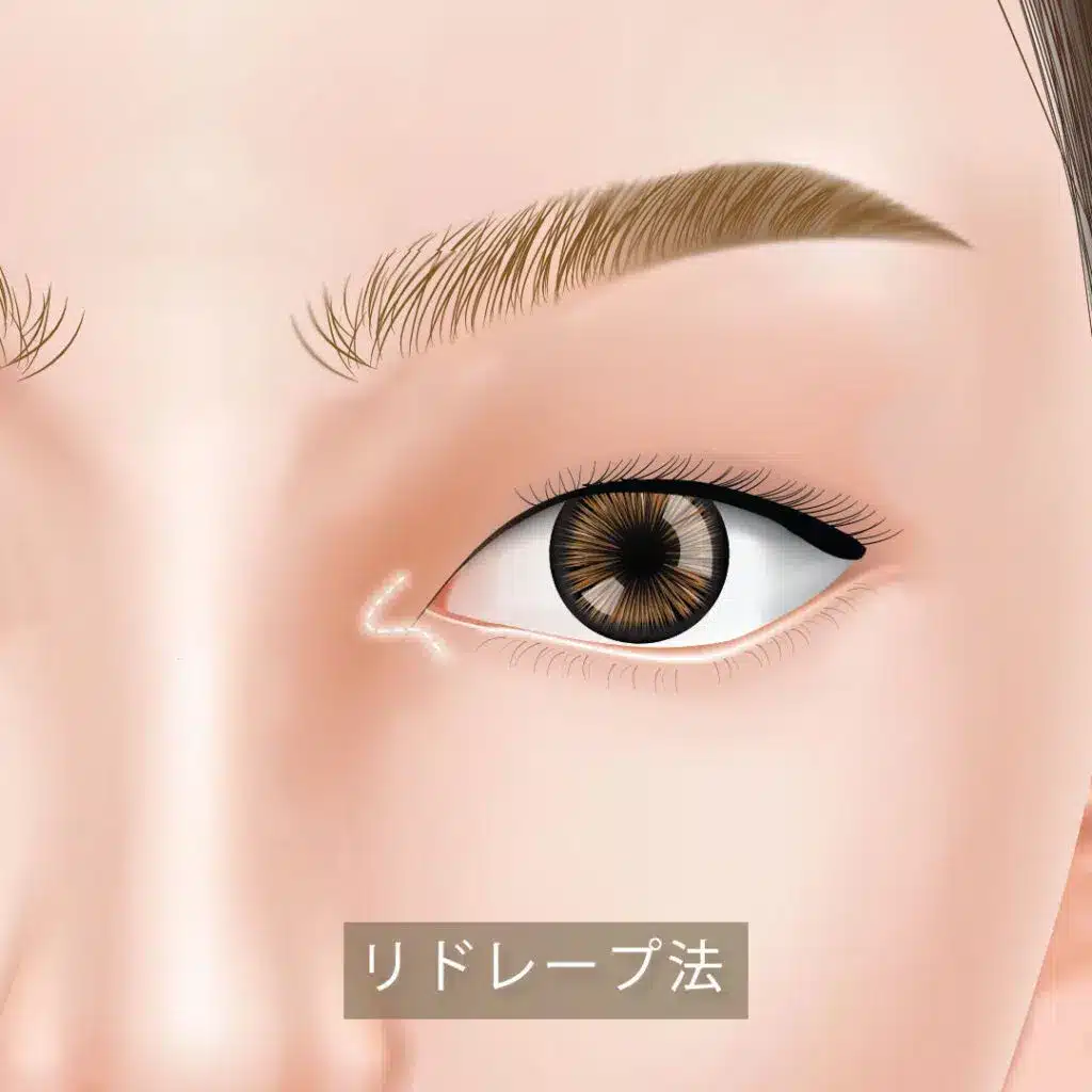 目頭切開切開_リドレープ形成
