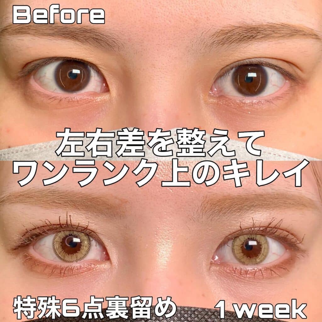 eclinic岡山院の埋没法(特殊6点裏留め)