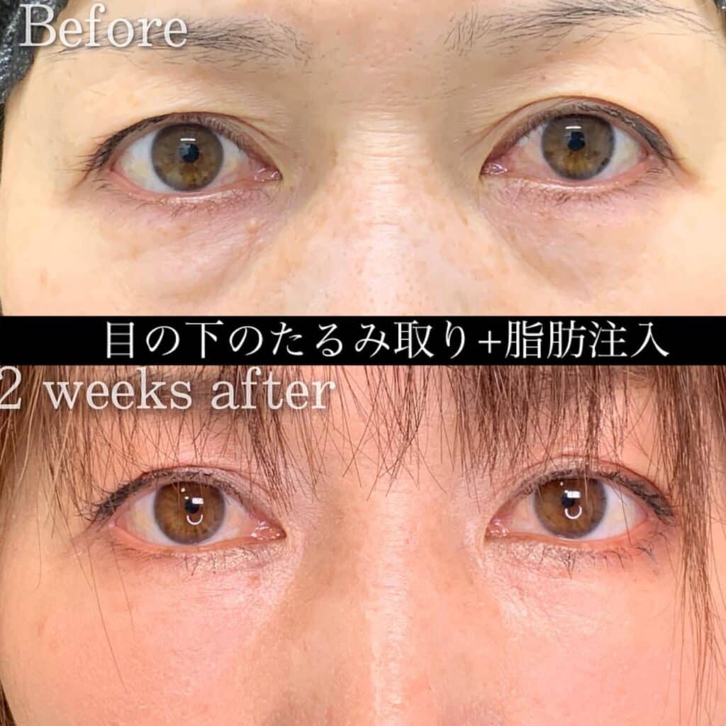 クマ取り_脱脂+脂肪注入の症例写真
