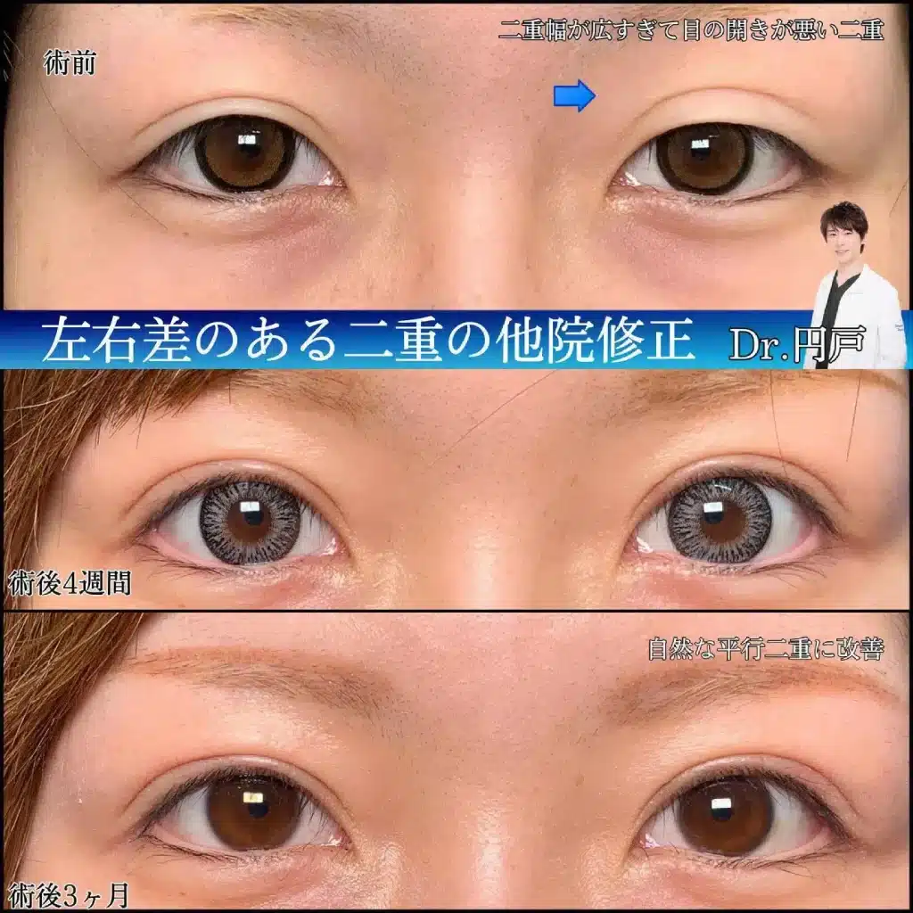 eclinic岡山院の二重埋没法の他院修正