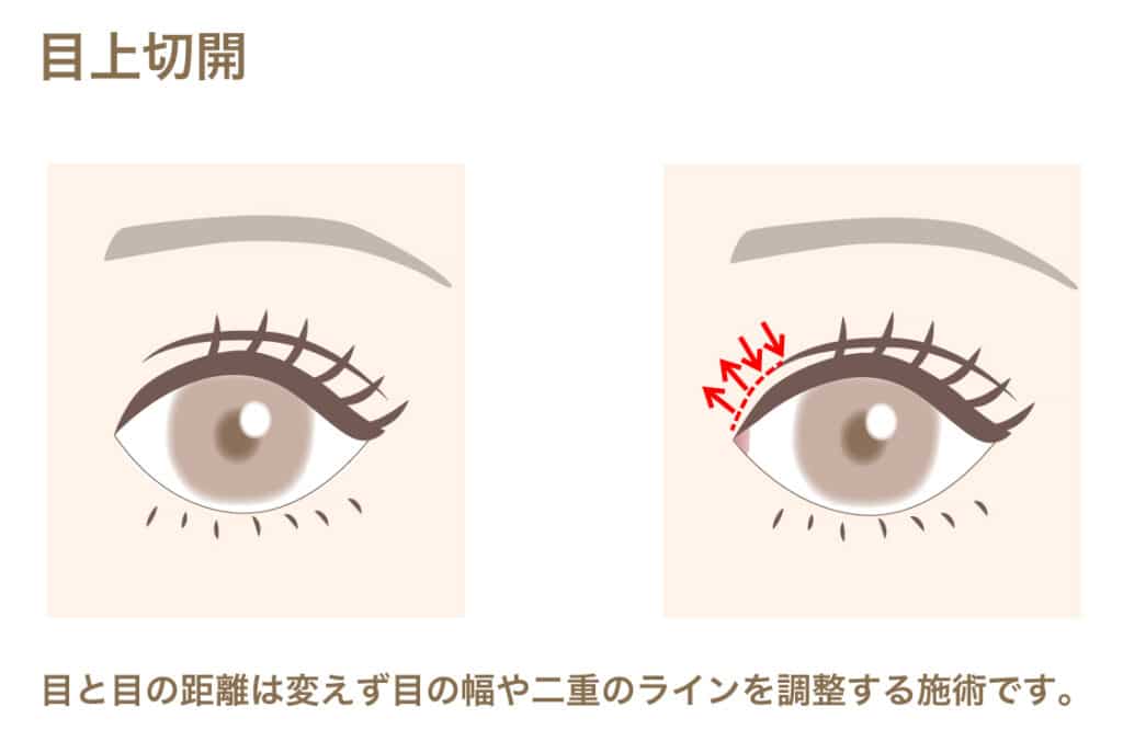 目上切開を説明している画像