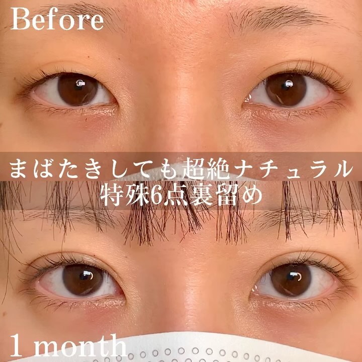 eclinic岡山院の埋没法(特殊6点裏留め法)