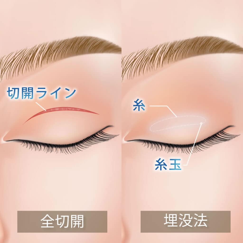 全切開と埋没法