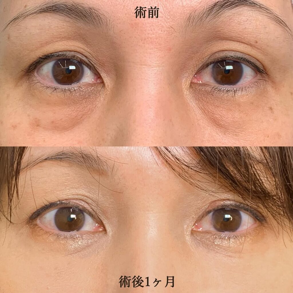 eクリニック岡山院の経結膜脱脂＋脂肪注入