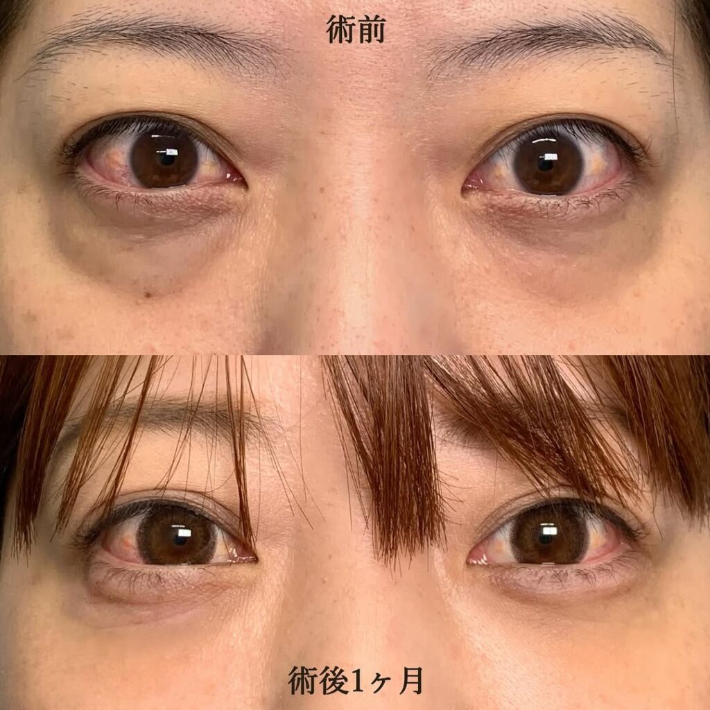 eクリニック岡山院の経結膜脱脂＋脂肪注入