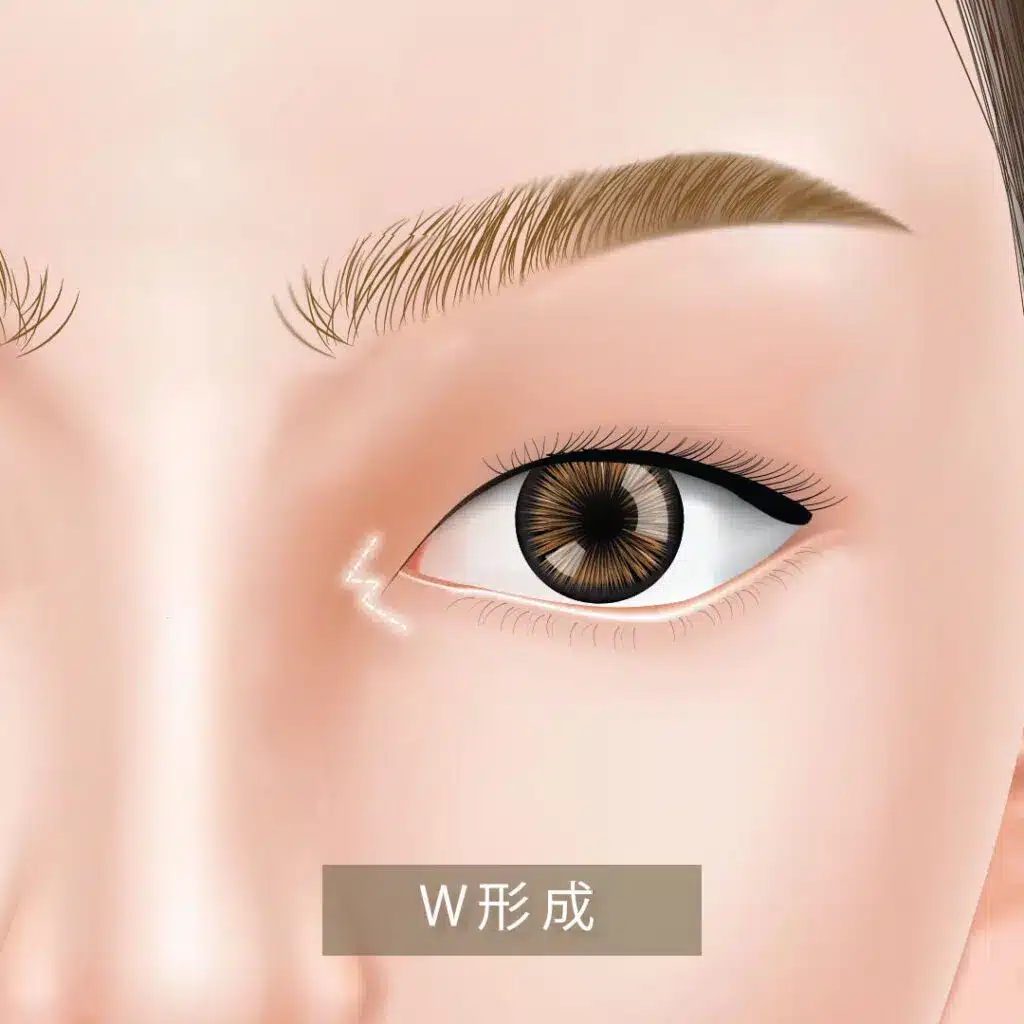 目頭切開切開_w形成