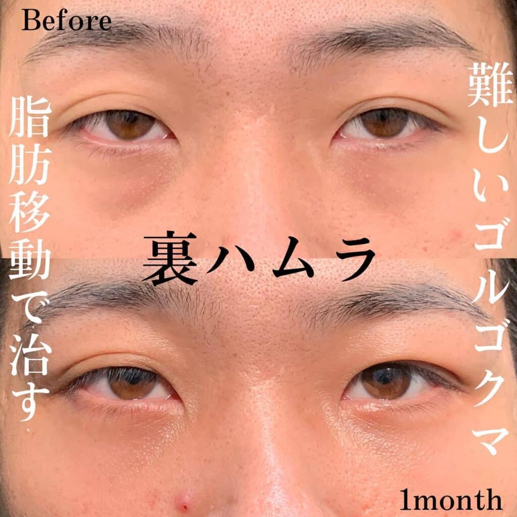クマ取り_裏ハムラ法の症例写真