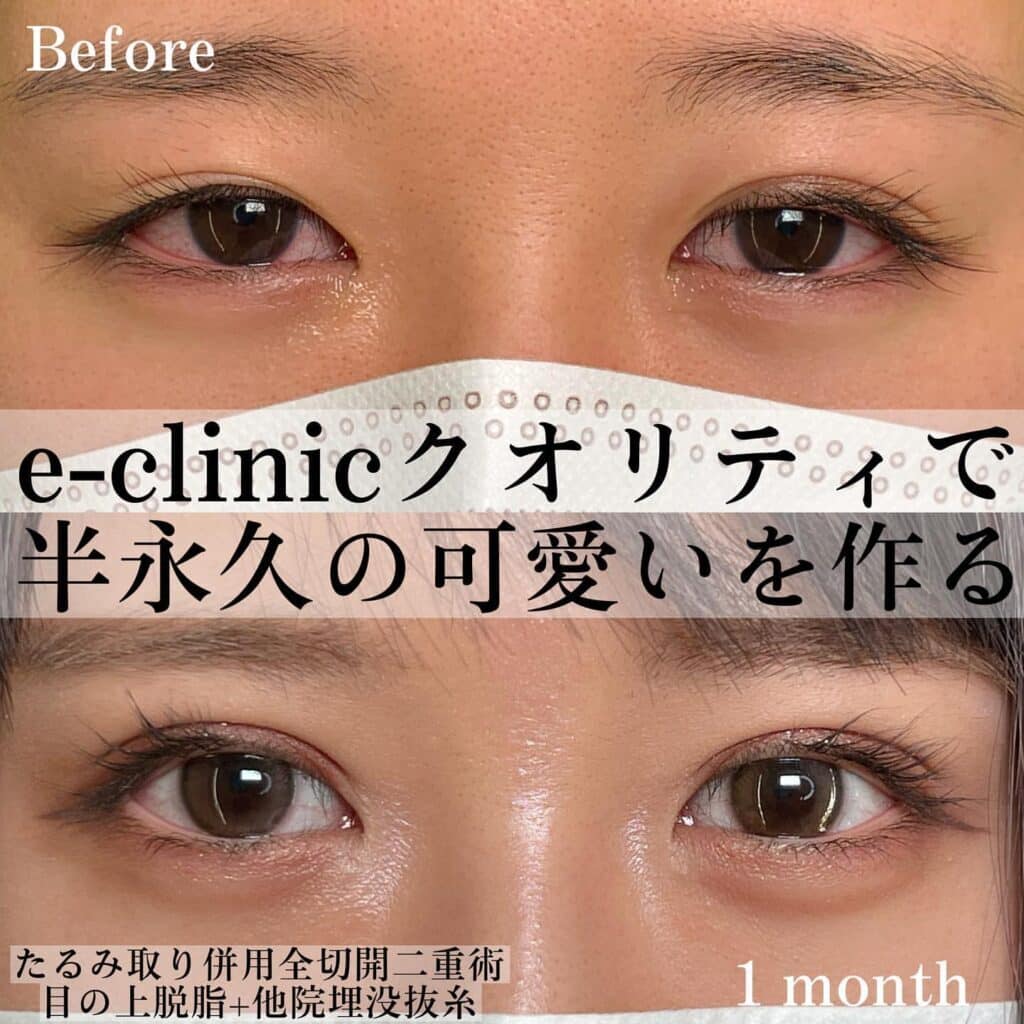eclinic岡山院の全切開二重術+目の上脱脂+他院埋没抜糸